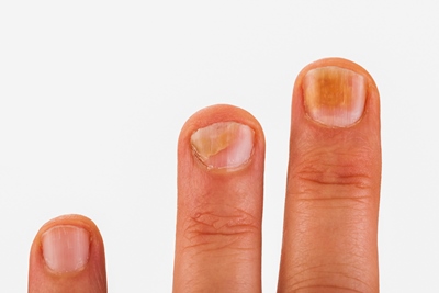 gljivice na noktima ruku liječenje